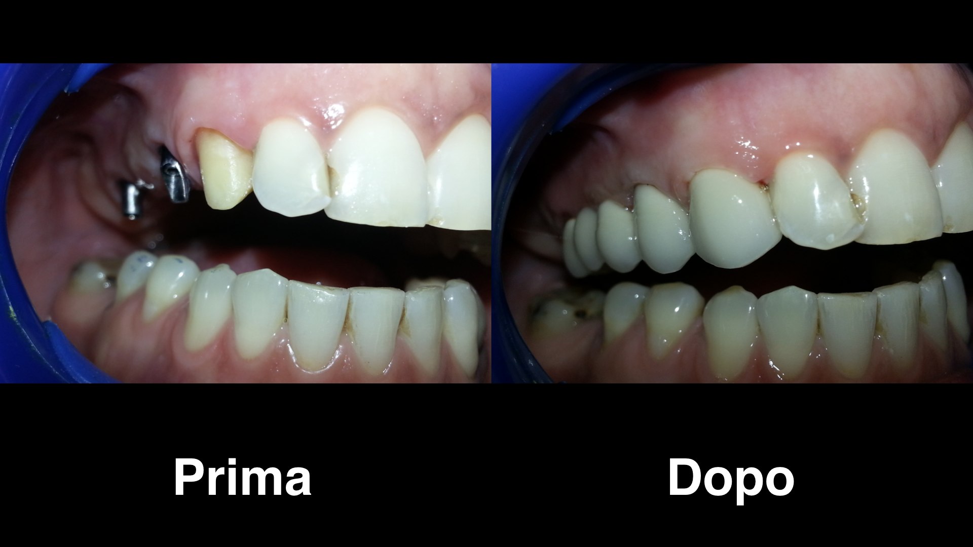 10 Inserti (caps) Di Ritenzione Per Impianti Dentali Overdenture