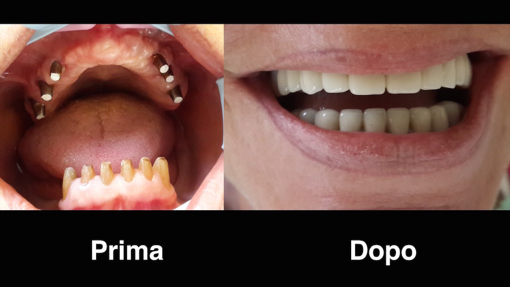 Tappi Di Ritenzione Per Protesi Su Pilastri 10 Inserti Per Protesi