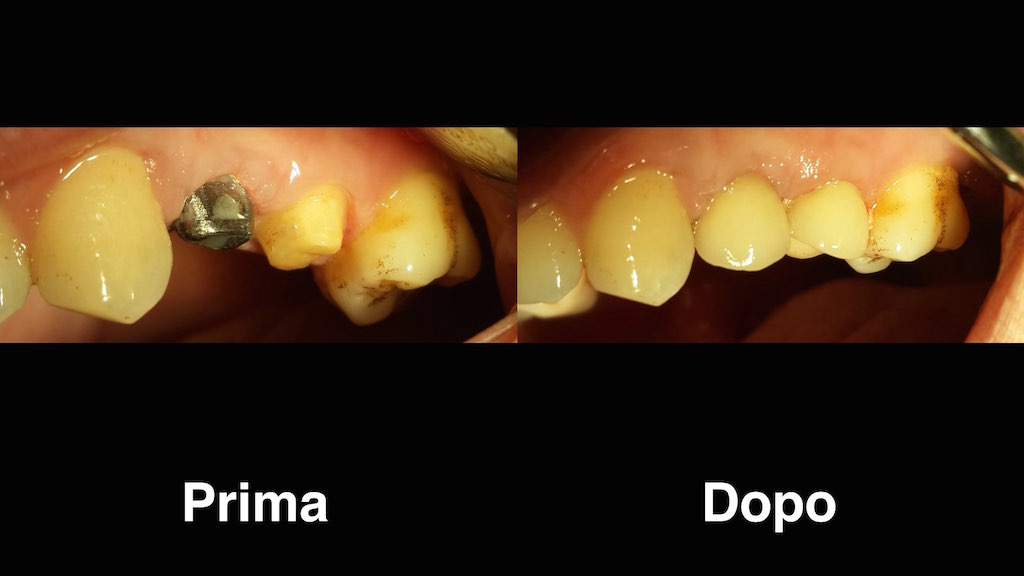 Vassoi Di Cottura Dentari Del Laboratorio, Vassoi Rotondi 2pcs Con 20 Pz Perni Di Sostegno, Materiale Di Zirconia, Conveniente Per Il Lavoro Del Dentista (ago Di Metallo - Foto 10